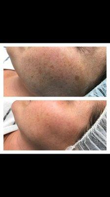 Before & After One IPL Photorejuvenation Treatment to reduce pigment/sun spots