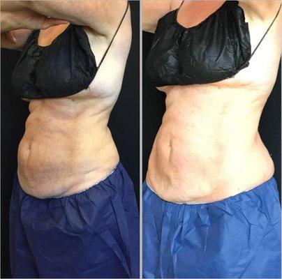 CoolSculpting targets and kills specific fat cells on the Abdomen yielding these impressive results after 3 treatments.