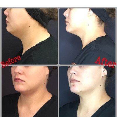 Before and after SculpSure for the chin area.