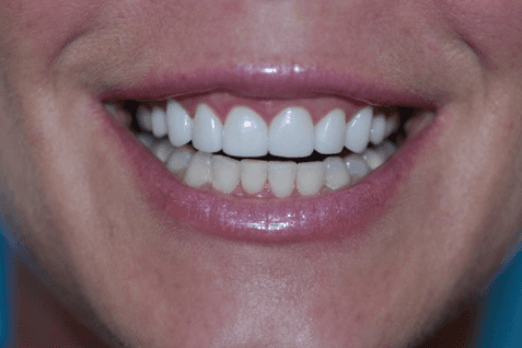 After First Choice Dental veneers