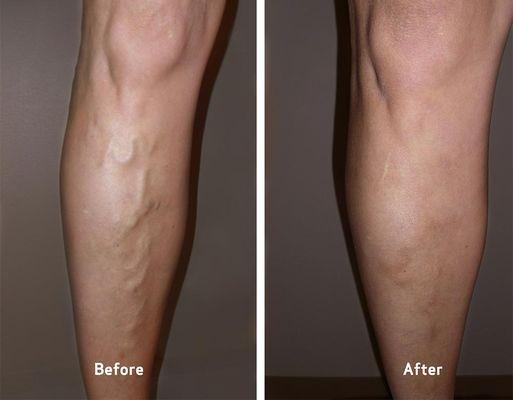 Before and After at USA Vein Clinics