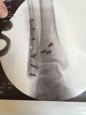 Screws and rods after surgery