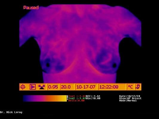 Radiation-free breast cancer screening.