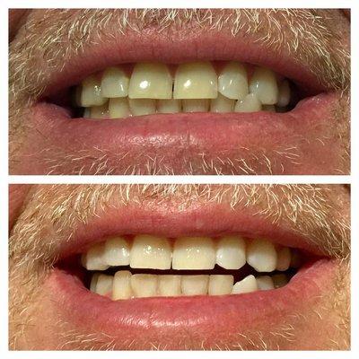 First Glance Teeth Whtiening Client - Before & After