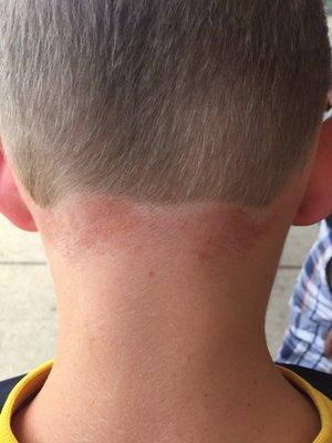 This is the razor burn from his haircut...