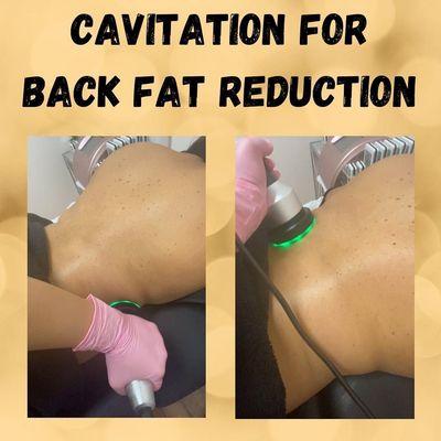 Fat reduction