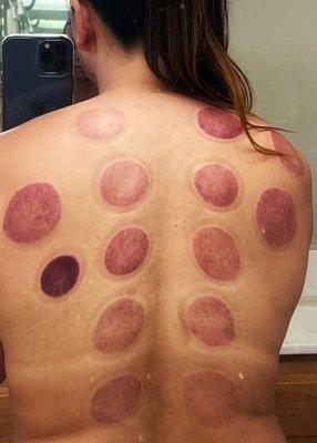 Cupping done right.