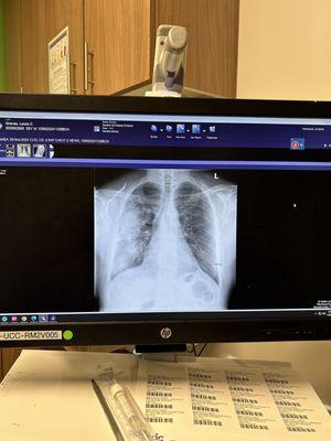 What pneumonia looks like in a chest x-ray.