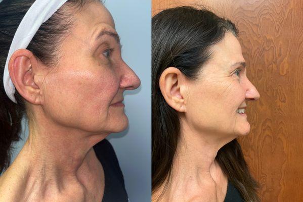 Results after 3 Potenza RF Microneedling and 3 IPL treatments. We targeted fine lines and wrinkles, discoloration, and more!