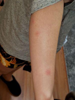 Bedbug bites.