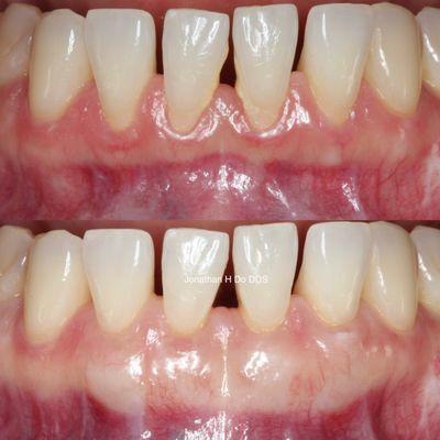 Before and after gum graft