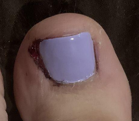 Bloody toe!