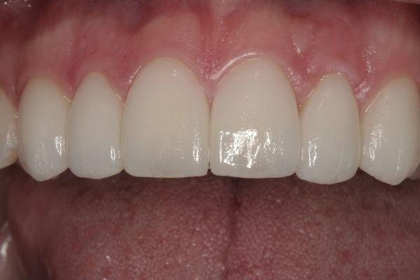 Close up of porcelain veneers