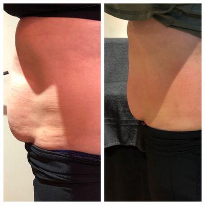 1 Fire & Ice body treatment. Results are immediate