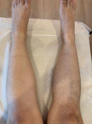 Side by side of lower leg sugaring.