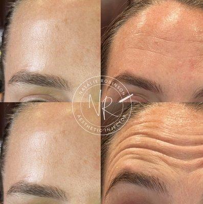 Daxxify Wrinkle Treatment