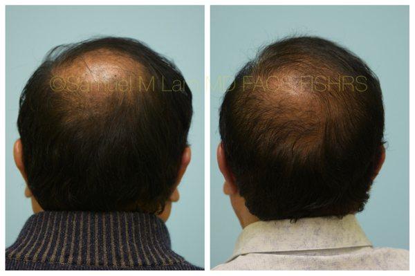 This 69-year-old patient is shown before and six months following a hair transplant into his frontal scalp/ midscalp, crown, and temples