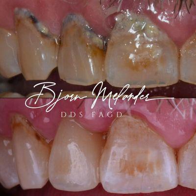 Same day Cerec crowns can be stained and glazed to match existing teeth, no need to visit the lab for a custom shade and a two week wait!