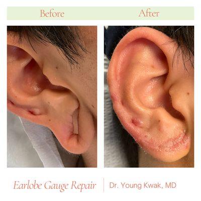 Earlobe Gauge Repair by Dr. Young Kwak