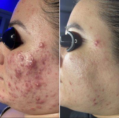 Upgraded Acne Treatment Series