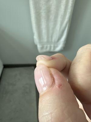 The thickness under the pinky and where I was cut on my thumb.