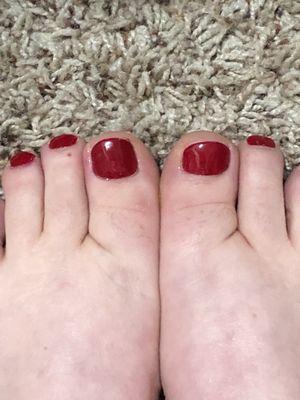 Right toenail cut shorter than the left