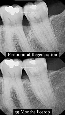 Periodontal regeneration