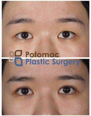 Upper eyelid surgery by Dr. Chaboki