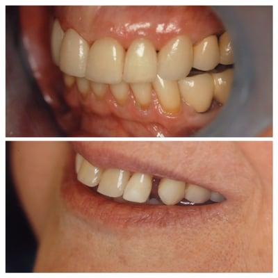 Closing Diastema(Gap)