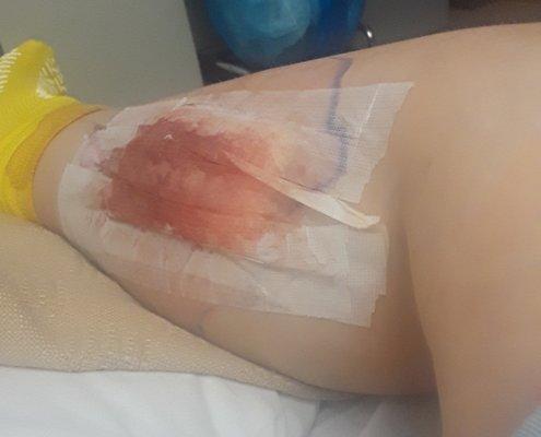 this was my leg right after surgery