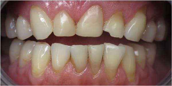 Before gingival and bone contouring (Crown Lengthening)