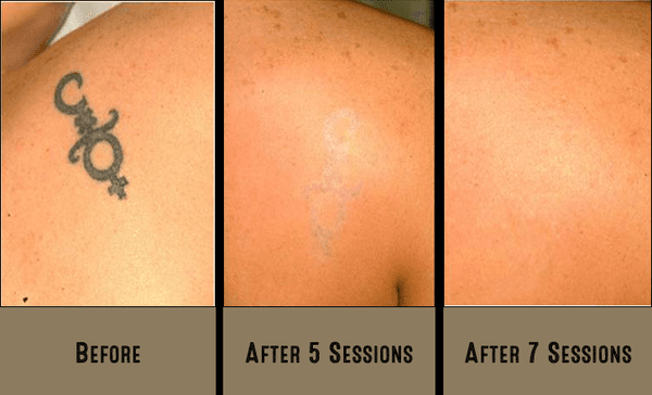 Another successful removal with 7 sessions - no residual and no scarring!