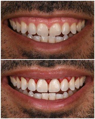 Gum Lift (gingivectomy and crown lengthening) smile makeover- after picture was taken immediately after surgery, 1 hr apart!