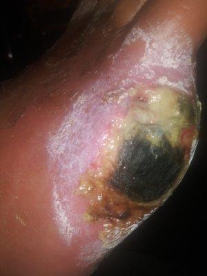 This is what happened to my Dad's foot following toe amputation! BEWARE!!!!