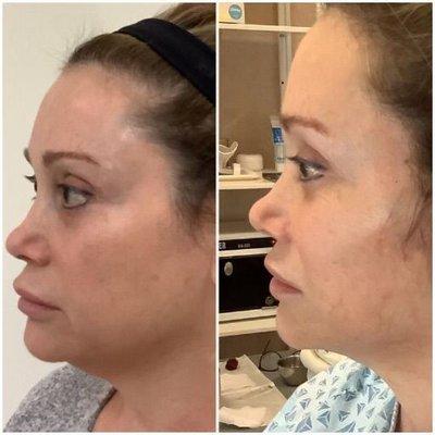 Before/ After. Face lift by Dr. Joseph.