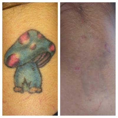 Before and after 10 complete treatments