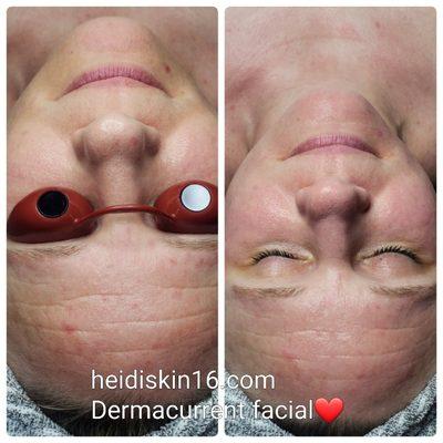 Dermacurrent facial is making your skin goals fast