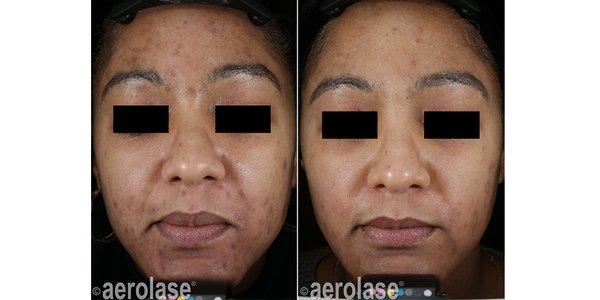 Before and after Acne Laser treatment - Gentle laser safe and all skin types