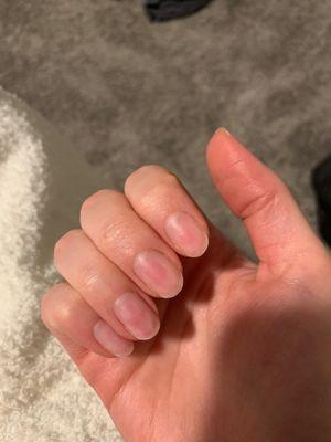 Finger nails post removal