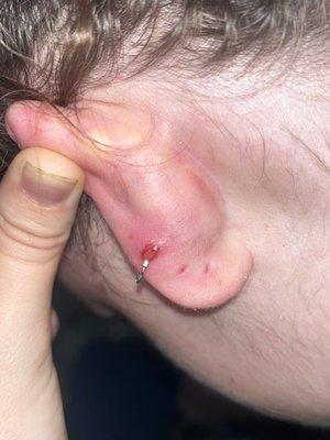 Infected piercing 6 months later