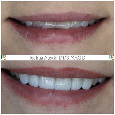 Porcelain Crowns are a great option for thinning or worn teeth.