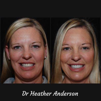 Dr Heather Anderson replaced her patient's old, discolored crowns with all-porcelain crowns to enhance her smile :)