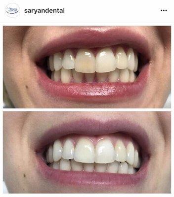 Internal bleaching on discolored tooth 1 week after bleaching procedure