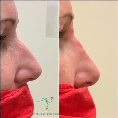 Non surgical rhinoplasty