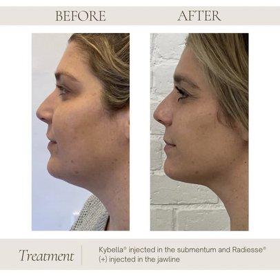 Before and after Kybella with dermal filler in the jawline to create a sharper, more defined jawline in a female client