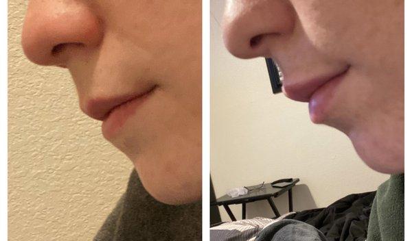 1 syringe of lip filler  (Left: before | right: after)