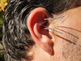 Ear Acupuncture