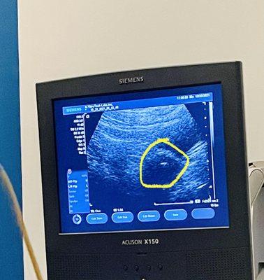 Ultrasound showing that the embryos implanted  two weeks later we found out we're having a baby