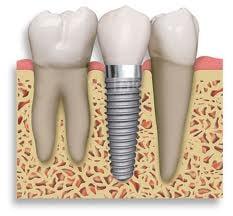 Dental Implants