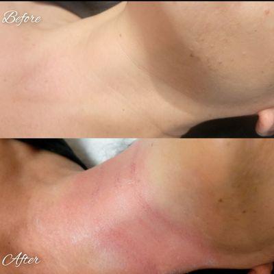 Fibroblast plasma pen helps wrinkles virtually disappear. Necklace lines on neck (Before & Immediately after treatment).